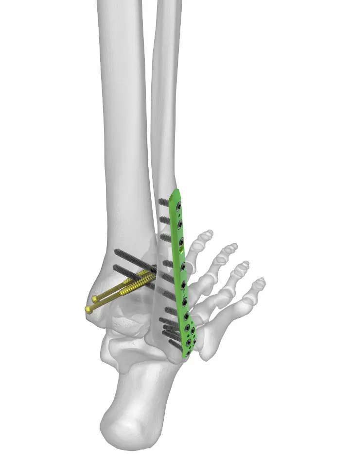 tornillos para fractura de tibia y perone - Cuánto cuesta una operación de fractura de tibia y peroné