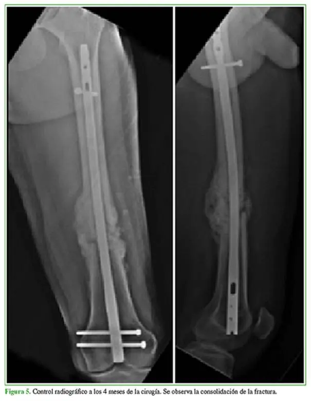 tornillo endomedular - Cuánto tarda en soldar un hueso con tornillo