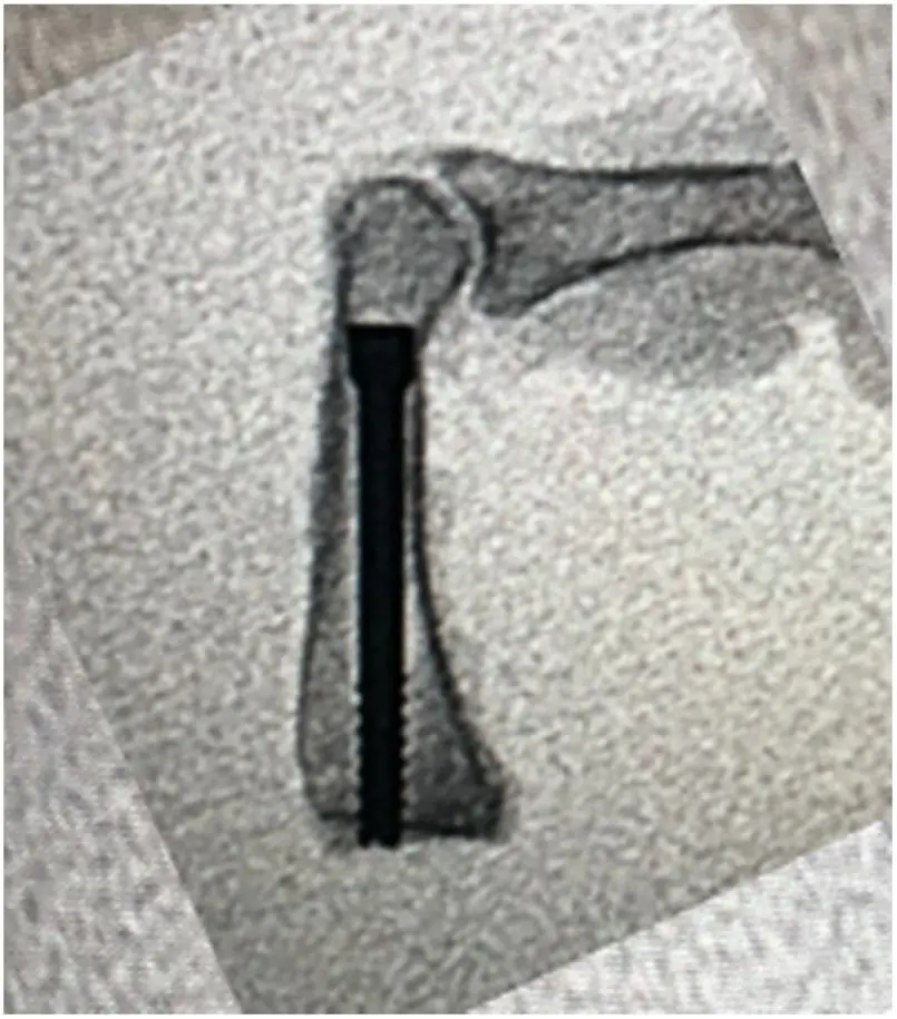 tornillo endomedular - Qué es endomedular