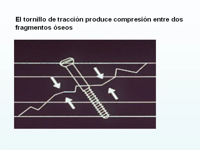 tornillo de compresion interfragmentaria - Qué es un tornillo interfragmentario
