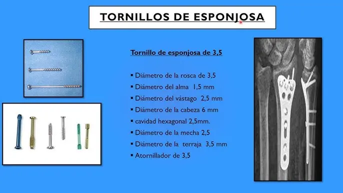 tornillo interfragmentario - Qué es un tornillo interfragmentario