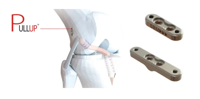 tornillos reabsorbibles rodilla - Qué son los tornillos reabsorbibles