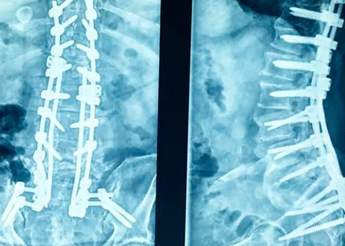 operacion de columna con tornillos - Qué tan delicada es una cirugía de columna